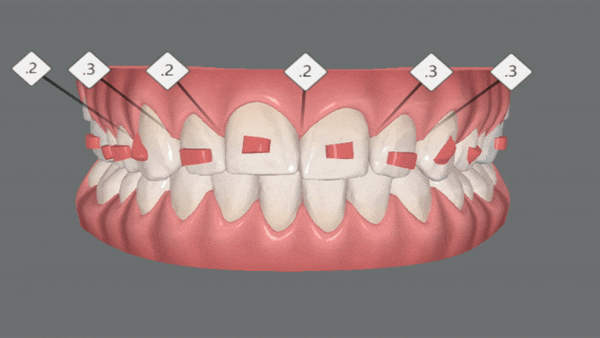 잠실교정치과 유펜바른치과의 인비절라인익스프레스가 특별한 이유 (5개월 인비절라인급속교정 잠실인비절라인 송파인비절라인 인비절라앞니부분교정) 관련 이미지 8