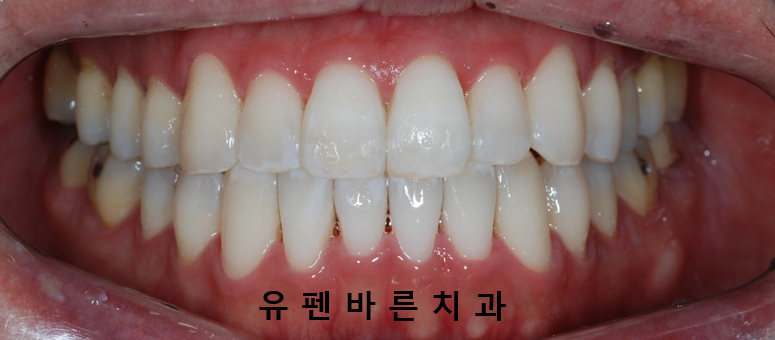 나스닥에 상장한 인비절라인, 잠실투명교정 잠실인비절라인 후기와 치아미백이 궁금하다면? 관련 이미지 11
