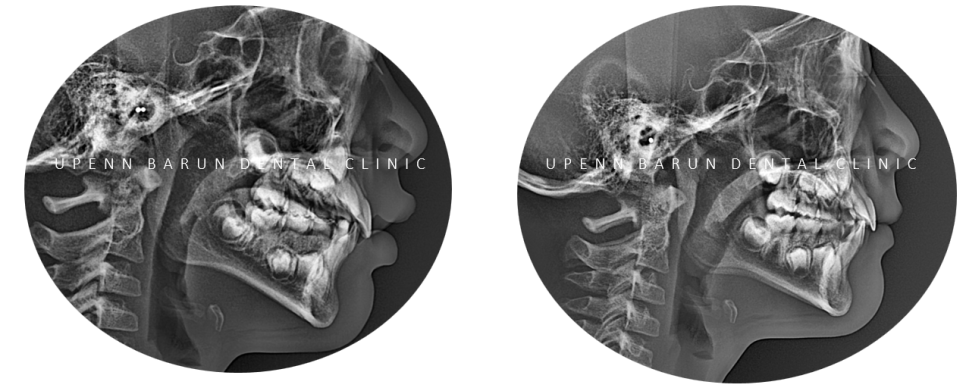 송파인비절라인퍼스트 인비절라인어린이교정 11개월만에 끝낸 후기(잠실인비절라인 잠실파인애플상가교정치과 인비절라인소아교정후기 인비절라인플래티넘엘리트등급) 관련 이미지 7