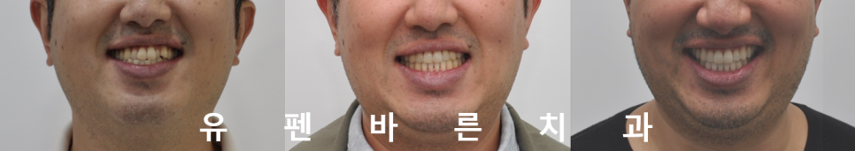 나스닥에 상장한 인비절라인, 잠실투명교정 잠실인비절라인 후기와 치아미백이 궁금하다면? 관련 이미지 19