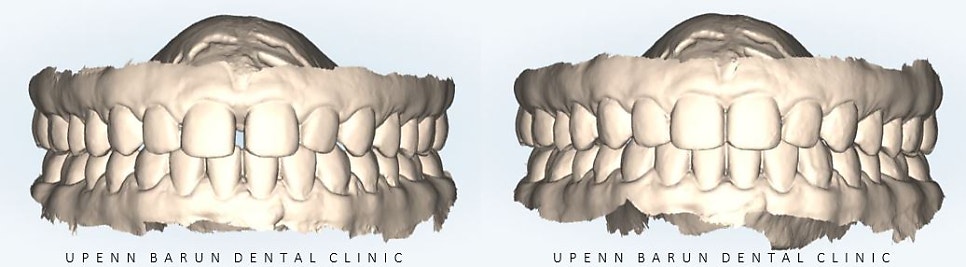앞니벌어짐 인비절라인익스프레스로 해결하기 (인비절라인앞니부분교정 인비절라인재교정 송파인비절라인 잠실인비절라인 잠실교정치과 인비절라인익스프레스비용) 관련 이미지 18