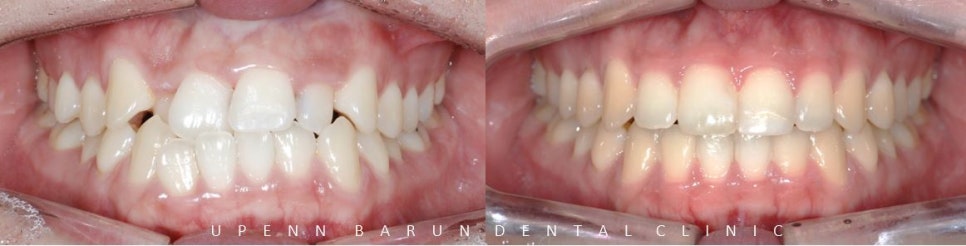 잠실데이몬교정, 비발치교정, 잠실덧니교정 (AKA Damon Smile) 관련 이미지 10