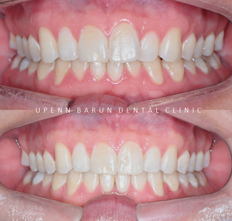 인비절라인을 시작할때 고려해야 하는 세가지 조건 (인비절라인다이아몬드 다이아몬드등급치과 인비절라인앞니교정 앞니급속교정 비발치교정 치간삭제 치간삭제양) 관련 이미지 6