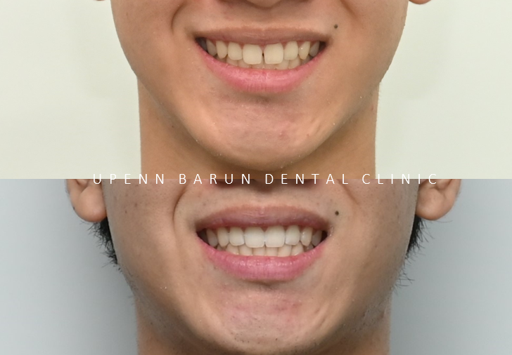 인비절라인다이아몬드등급치과에서 7주만에 앞니벌어짐 고민 해결한 후기(인비절라인앞니교정 인비절라인익스프레스 잠실인비절라인 인비절라인앞니교정후기) 관련 이미지 4