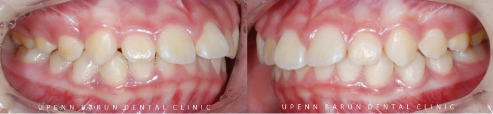 잠실새내역청소년교정 잠실돌출입발치교정은 유펜바른치과!(잠실중학생발치교정 잠실무턱교정 잠실새내소아교정치과 잠실새내교정잘하는치과 발치교정외모변화) 관련 이미지 6