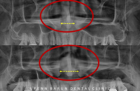 ABO 미국 치과교정과 전문의의 비수술치아교정 악궁확장장치 후기 (잠실교정전후 잠실새내교정치과 잠실교정치과 교정통증  앞니 변화) 관련 이미지 15