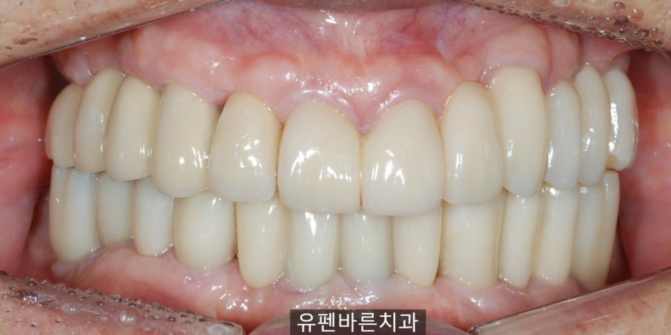 연세가 엄청 많으신데도 전체 임플란트 수술이 가능하다구요? 관련 이미지 6