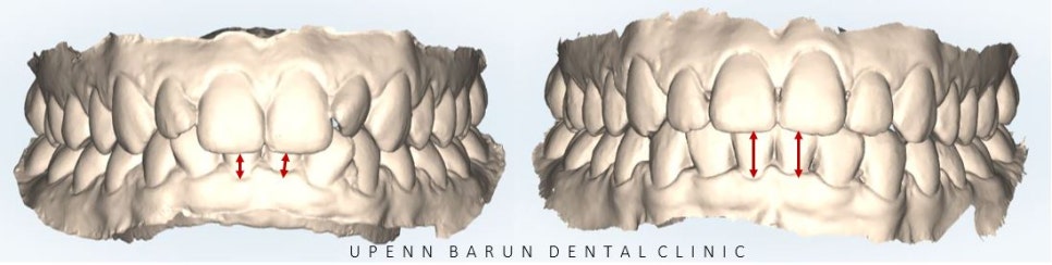 비발치 세라믹교정 후기 (앞니교정 잠실부분교정 잠실교정치과 잠실새내교정치과) 관련 이미지 5