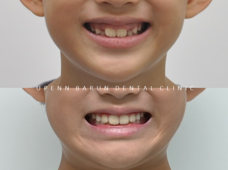 송파인비절라인퍼스트 인비절라인어린이교정 11개월만에 끝낸 후기(잠실인비절라인 잠실파인애플상가교정치과 인비절라인소아교정후기 인비절라인플래티넘엘리트등급) 관련 이미지 20