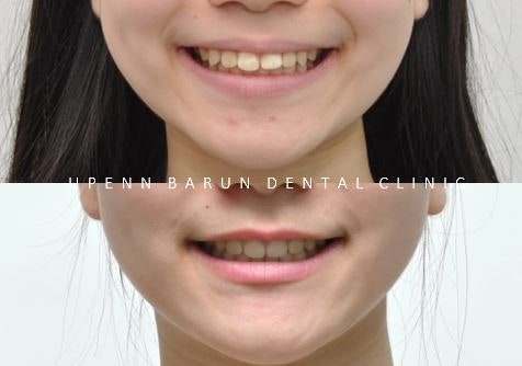 잠실새내역청소년교정 잠실돌출입발치교정은 유펜바른치과!(잠실중학생발치교정 잠실무턱교정 잠실새내소아교정치과 잠실새내교정잘하는치과 발치교정외모변화) 관련 이미지 11