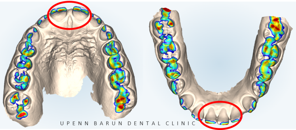 인비절라인높은등급 인비절라인플래티넘엘리트 잠실교정치과 잠실인비절라인 (잠실교정치과 송파인비절라인 인비절라인전후사진 인비절라인후기) 관련 이미지 4