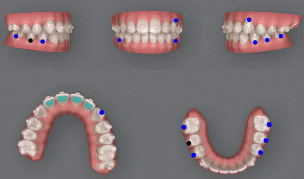 잠실소아인비절라인 잠실어린이인비절라인 송파인비절라인 잠실인비절라인후기 (잠실새내교정치과 엘스상가교정치과 파인애플상가교정치과 잠실새내역인비절라인 청소년교정후기 잠실인비절라인퍼스트) 관련 이미지 12
