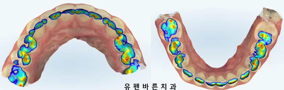 예전에 교정했는데 앞니가 뻐드러져서 컴플렉스에요! ( 비발치교정 인비절라인으로 재교정 해볼까요?) 관련 이미지 10