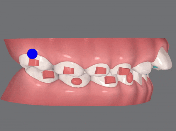 저도 친구들이 많이 하는 인비절라인교정 하고싶어요! 관련 이미지 5