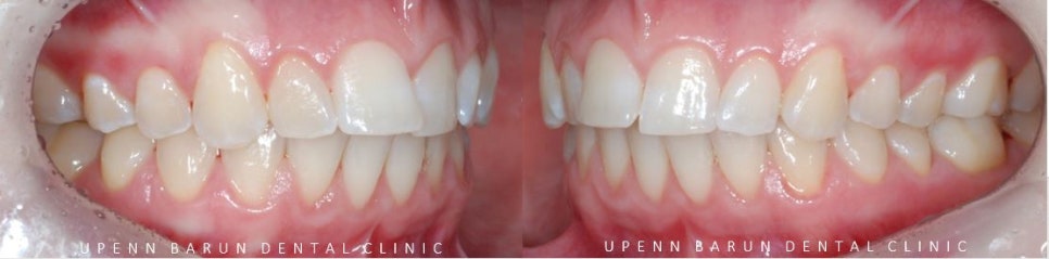 잠실교정치과 유펜바른치과의 인비절라인익스프레스가 특별한 이유 (5개월 인비절라인급속교정 잠실인비절라인 송파인비절라인 인비절라앞니부분교정) 관련 이미지 5