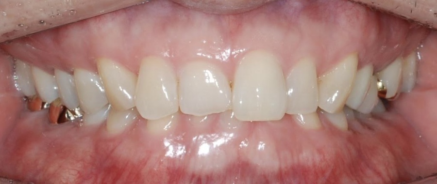 미니튜브를 이용한 MTA 교정 (앞니 부분 교정) 관련 이미지 11