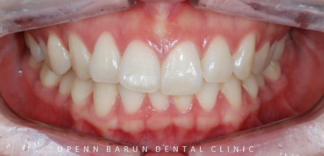 앞니부분교정 인비절라인라이트로 해결하기 (잠실인비절라인치과 송파인비절라인치과 잠실새내인비절라인치과 강동인비절라인치과 헬리오시티인비절라인 송파역인비절라인 석촌역인비절라인) 관련 이미지 5