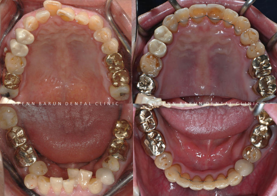 평생 삐뚤어진 치아가 고민이셨던 79세 고령환자분이 선택한 송파인비절라인다이아몬드등급 후기 (서울인비절라인전문치과 잠실인비절라인교정치과 노인교정 노인치아교정 노인교정치과) 관련 이미지 16