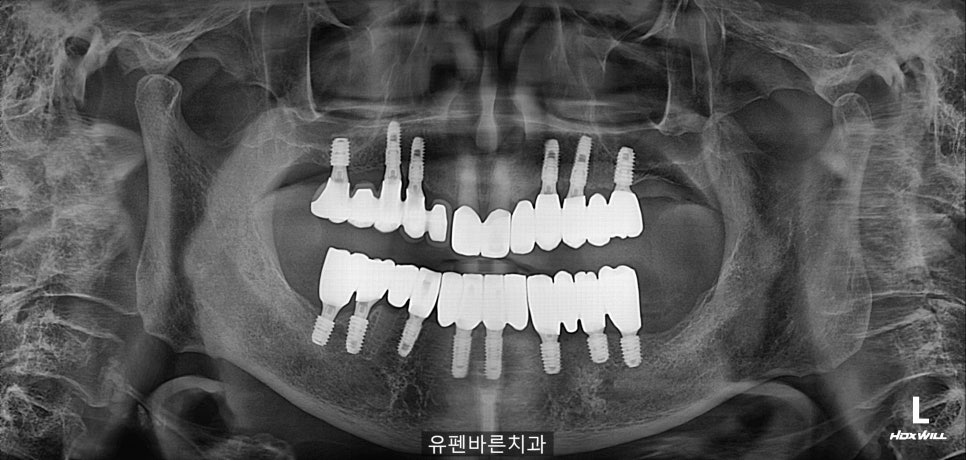 연세가 엄청 많으신데도 전체 임플란트 수술이 가능하다구요? 관련 이미지 4