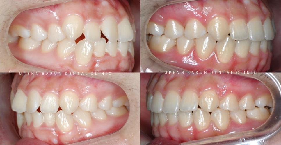 유학생치아교정 유학생교정치과 잠실교정치과 잠실데이몬교정 데이몬클리어교정 Wide Smile (송파교정치과 잠실새내교정치과 강동교정치과 헬리오시티교정치과 예쁜미소 Smile Arc) 관련 이미지 12