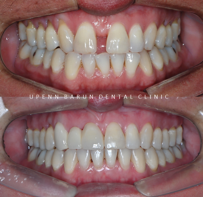 같은원장님께 보철치료와 교정치료를 동시에! 앞니사이 틈 해결한 후기 ( 송파교정치과 잠실교정잘하는치과 송파교정잘하는치과 올림픽파크포레온교정치과 올림픽파크포레온인비절라인치과) 관련 이미지 4