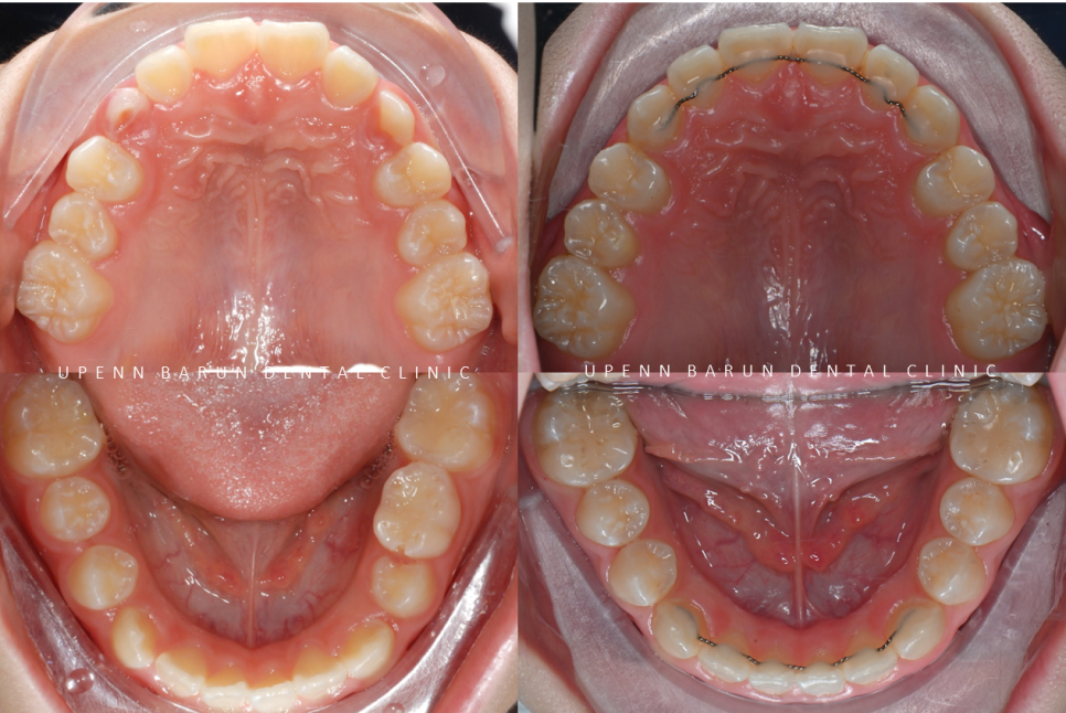 송파인비절라인다이아몬드등급치과 에서 인비절라인으로 1차 2차 교정을 한번에! (송파인비절라인퍼스트 잠실어린이인비절라인 인비절라인소아교정 잠실소아교정 어린이반대교합) 관련 이미지 18