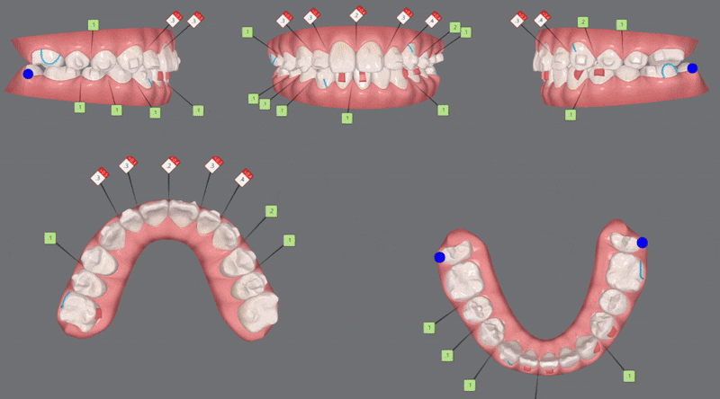 2024년 송파구 단일 치과의원급 중 유일!!! 인비절라인다이아몬드등급 달성한 유펜바른치과의 청소년인비절라인 후기 (청소년반대교합 어린이반대교합 잠실인비절라인잘하는치과) 관련 이미지 13