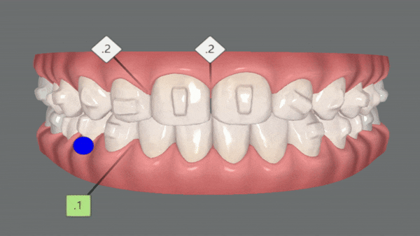 앞니벌어짐 인비절라인익스프레스로 해결하기 (인비절라인앞니부분교정 인비절라인재교정 송파인비절라인 잠실인비절라인 잠실교정치과 인비절라인익스프레스비용) 관련 이미지 10