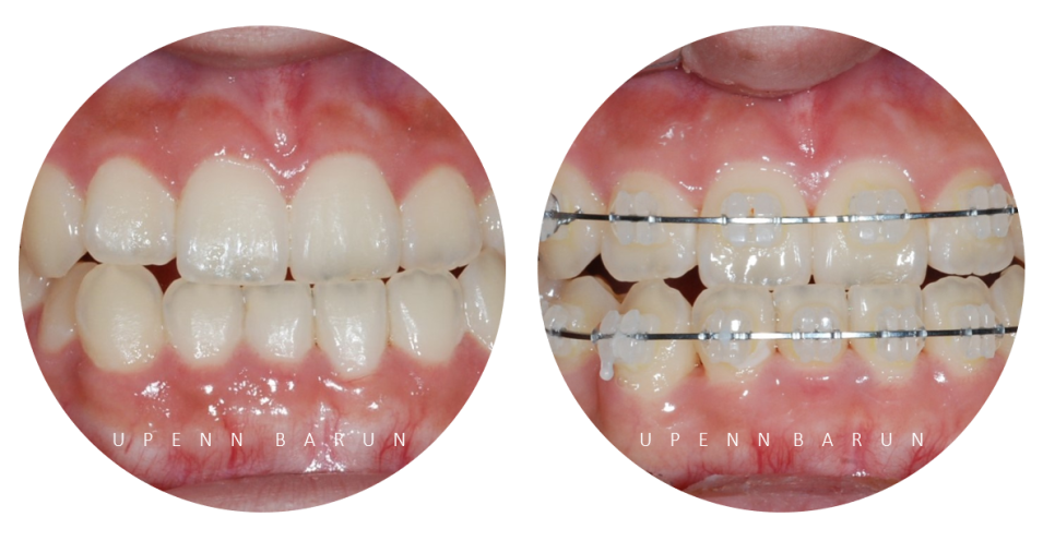 주걱턱교정, 수술교정, 양악수술도 잠실교정치과 유펜바른치과에서 관련 이미지 9