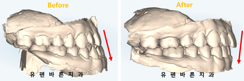 주걱턱교정, 수술교정, 양악수술도 잠실교정치과 유펜바른치과에서 관련 이미지 10