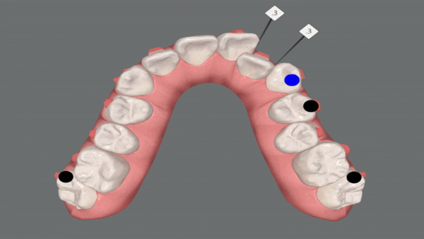 '웃을때 입을 자꾸 가려요'  활짝 웃은 중학생 비발치 인비절라인후기 (잠실새내인비절라인 청소년인비절라인 잠실교정치과) 관련 이미지 5