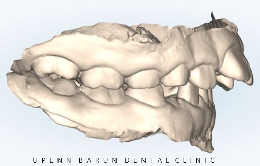 유독 튀어나와 다치기 쉬운 앞니! INVISALIGN FIRST로 8개월만에 끝낸 후기 (송파인비절라인소아교정 인비절라인1차교정 송파인비절라인퍼스트  송파인비절라인어린이교정) 관련 이미지 12