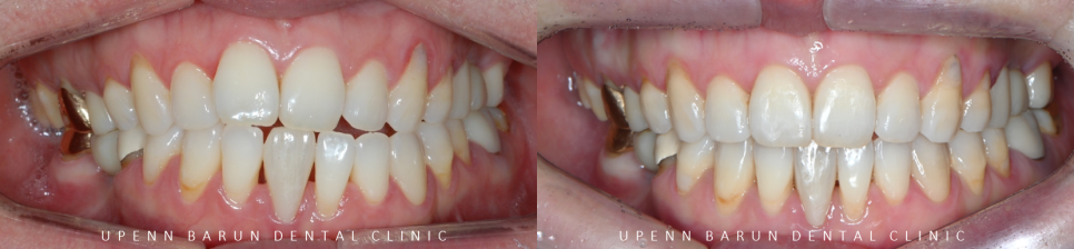 인비절라인 공식 스피커가 상주하고 치료하는 송파교정잘하는치과 유펜바른치과 (잠실성인교정 잠실재교정 잠실인비절라인 성인인비절라인교정 잠실나루역교정치과 문정동교정치과 삼전역교정치과) 관련 이미지 16