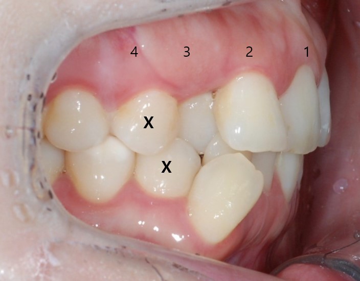 해외거주 중인데 발치교정도 인비절라인으로 가능한가요? 관련 이미지 3