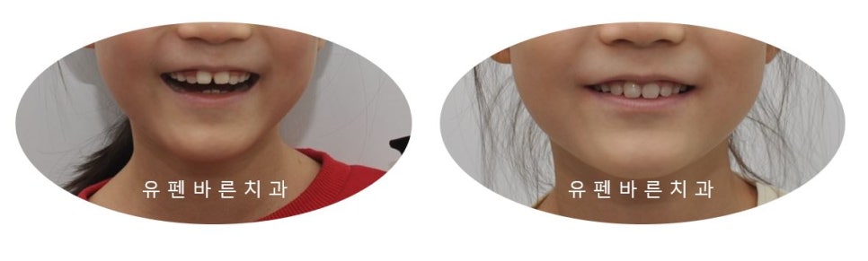 저도 친구들이 많이 하는 인비절라인교정 하고싶어요! 관련 이미지 12