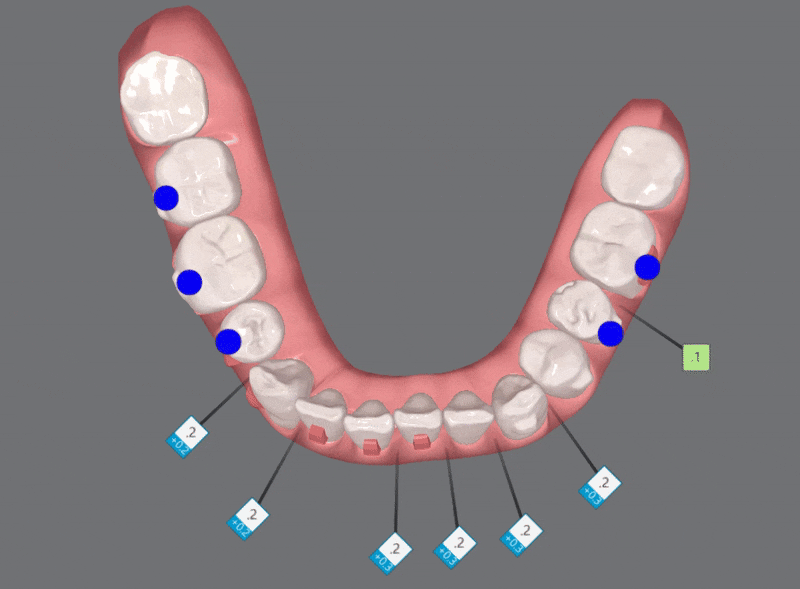 평생 삐뚤어진 치아가 고민이셨던 79세 고령환자분이 선택한 송파인비절라인다이아몬드등급 후기 (서울인비절라인전문치과 잠실인비절라인교정치과 노인교정 노인치아교정 노인교정치과) 관련 이미지 14