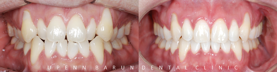 잠실덧니교정 인비절라인으로 컴플렉스 해결! (비발치교정 인비절라인등급 인비절라인후기 ) 관련 이미지 3