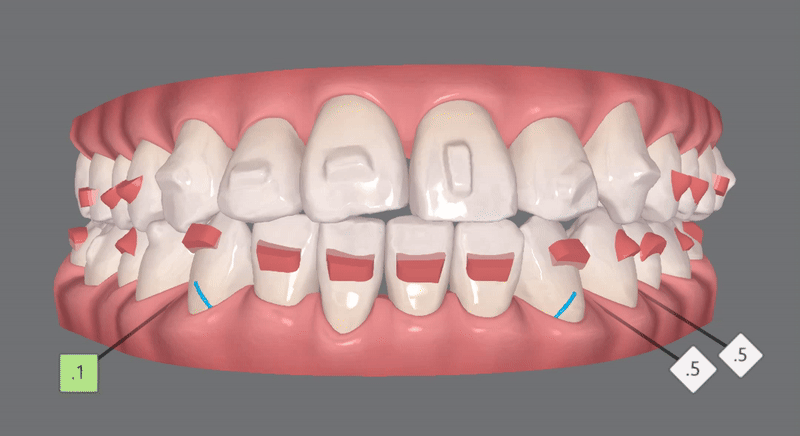 송파인비절라인다이아몬드등급 치과에서 악궁확장장치 없이 반대교합 해결한 후기(인비절라인높은등급 인비절라인반대교합 인비절라인비발치교정 인비절라인잘하는치과 인비절라인교정전문) 관련 이미지 9