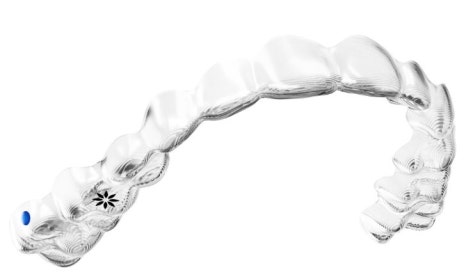 앞니벌어짐 인비절라인익스프레스로 해결하기 (인비절라인앞니부분교정 인비절라인재교정 송파인비절라인 잠실인비절라인 잠실교정치과 인비절라인익스프레스비용) 관련 이미지 13