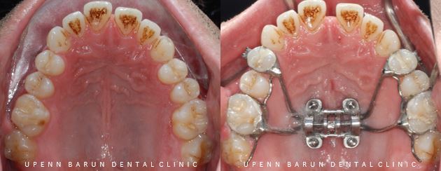ABO 미국 치과교정과 전문의의 비수술치아교정 악궁확장장치 후기 (잠실교정전후 잠실새내교정치과 잠실교정치과 교정통증  앞니 변화) 관련 이미지 9