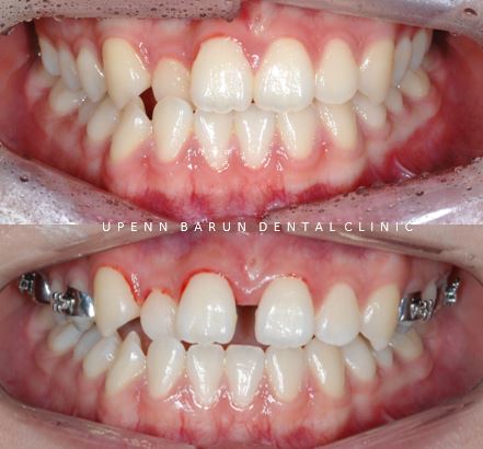 ABO 미국 치과교정과 전문의의 비수술치아교정 악궁확장장치 후기 (잠실교정전후 잠실새내교정치과 잠실교정치과 교정통증  앞니 변화) 관련 이미지 14