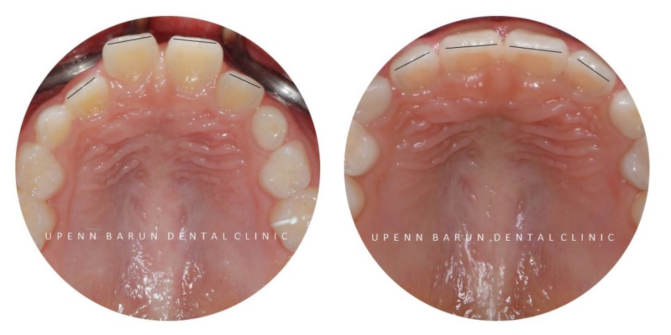 유독 튀어나와 다치기 쉬운 앞니! INVISALIGN FIRST로 8개월만에 끝낸 후기 (송파인비절라인소아교정 인비절라인1차교정 송파인비절라인퍼스트  송파인비절라인어린이교정) 관련 이미지 15