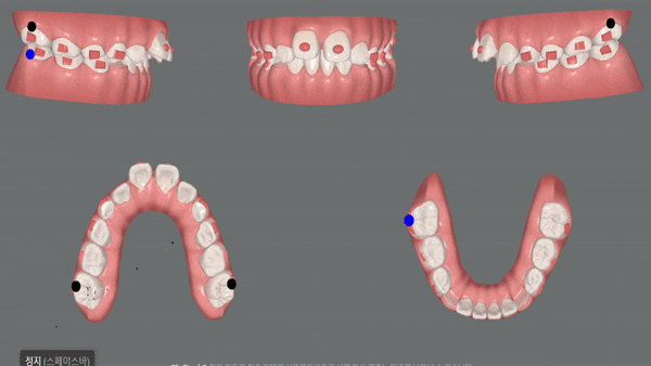 유독 튀어나와 다치기 쉬운 앞니! INVISALIGN FIRST로 8개월만에 끝낸 후기 (송파인비절라인소아교정 인비절라인1차교정 송파인비절라인퍼스트  송파인비절라인어린이교정) 관련 이미지 9