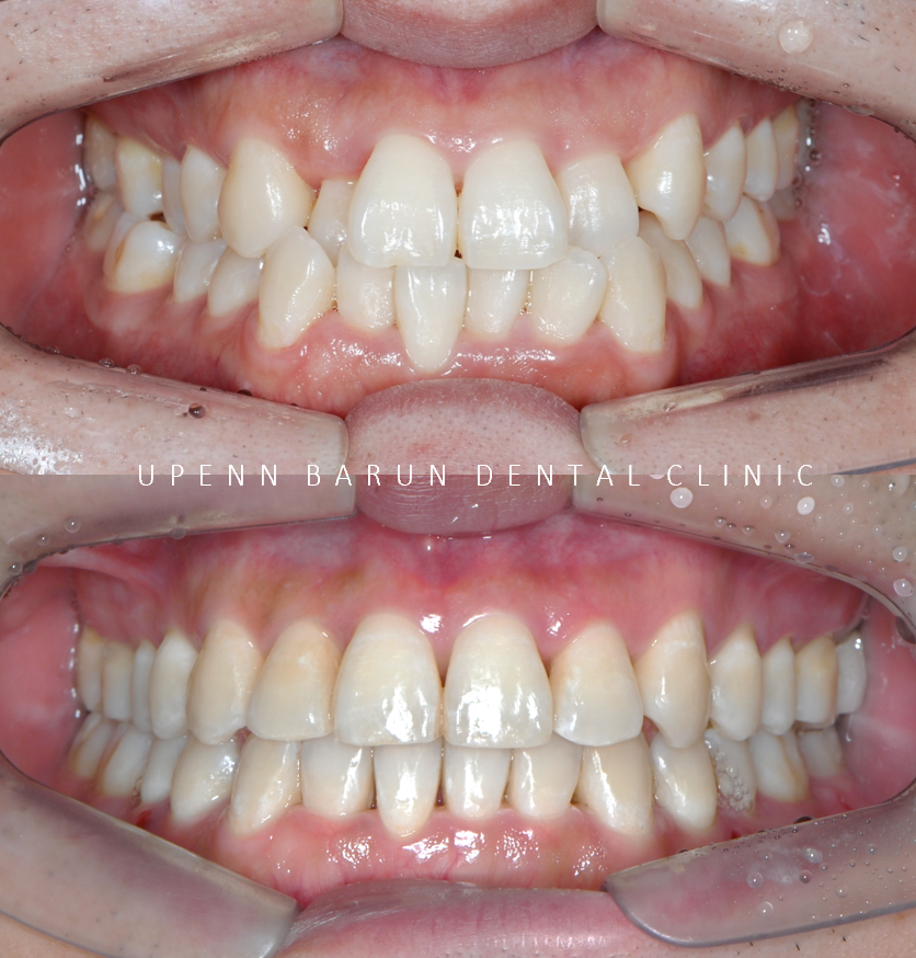 송파인비절라인다이아몬드등급 치과에서 악궁확장장치 없이 반대교합 해결한 후기(인비절라인높은등급 인비절라인반대교합 인비절라인비발치교정 인비절라인잘하는치과 인비절라인교정전문) 관련 이미지 5