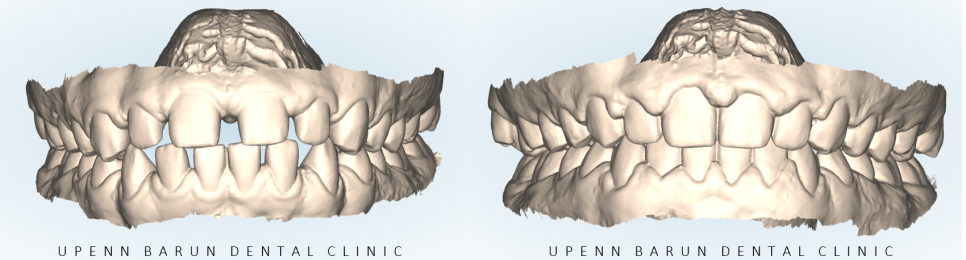 인비절라인높은등급 인비절라인플래티넘엘리트 잠실교정치과 잠실인비절라인 (잠실교정치과 송파인비절라인 인비절라인전후사진 인비절라인후기) 관련 이미지 7