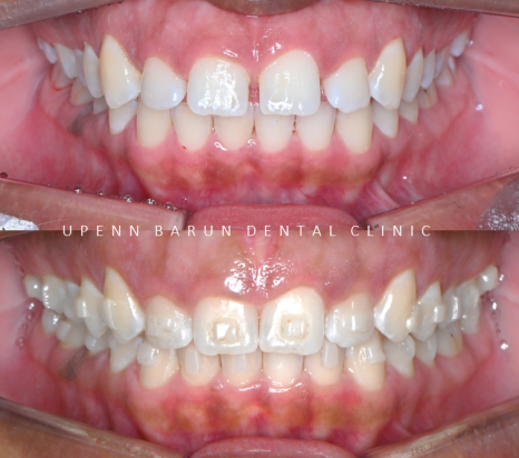잠실인비절라인등급 잠실부분교정 앞니틈교정 인비절라인라이트 옵션으로 빠르게 해결한 후기 (삼성역부분교정 인비절라인앞니재교정 잠실역교정치과 삼전동인비절라인 삼전동교정치과) 관련 이미지 9