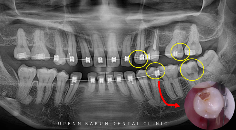 수술이 필요없는 잠실돌출입교정 잠실교정치과 입술이 잘 안다물어져 고민이라면? (돌출입전후 잠실새내교정치과 잠실발치교정 발치교정전후사진) 관련 이미지 6