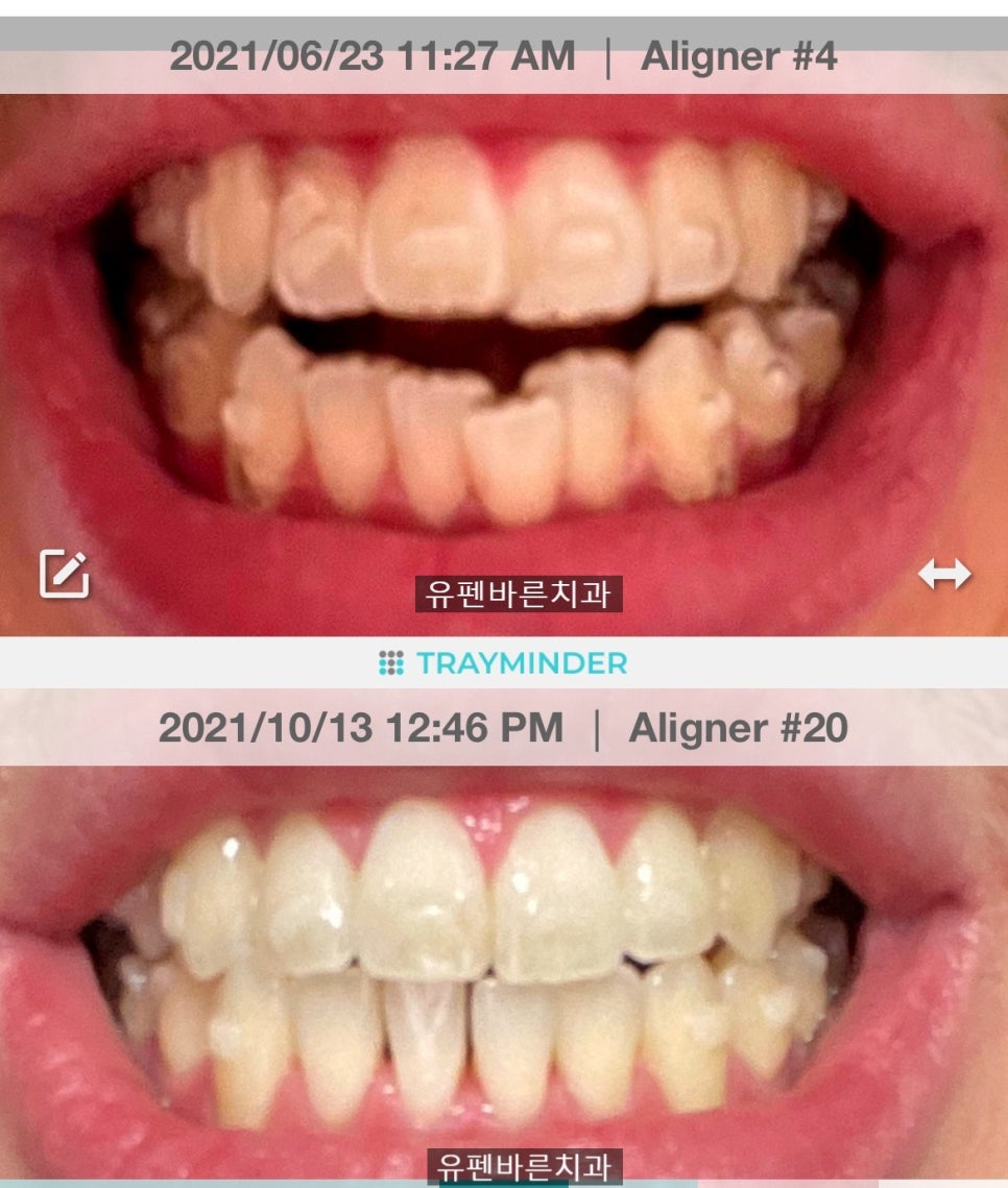 앞니끼리 맞물리지 않는데 인비절라인으로 교정 가능한가요? 관련 이미지 8