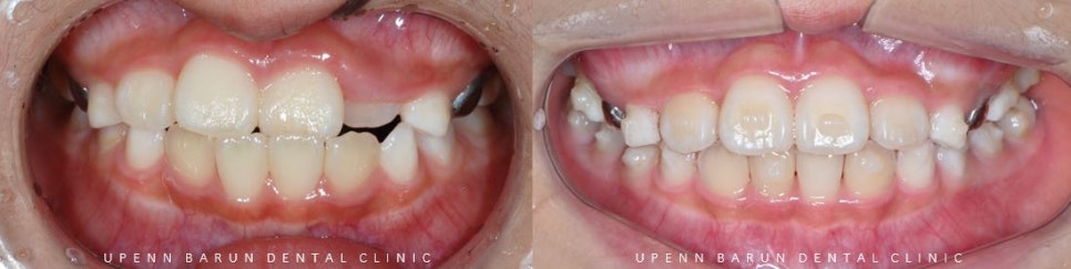 8세 어린이반대교합 인비절라인퍼스트로 수월하게 해결 후기! 잠실인비절라인퍼스트 잠실인비절라인소아교정 (잠실교정치과 잠실인비절라인 인비절라인등급 인비절라인후기 잠실소아교정) 관련 이미지 11