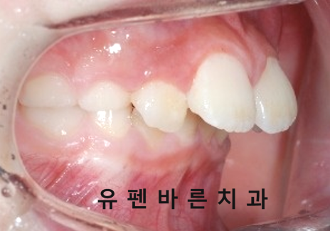 우리아이, 무턱교정 해야할까요? 관련 이미지 6